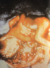foto de aborto
