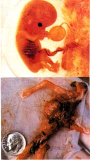 Asesinato en aborto por RU486 y por DIU